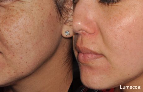 EVR_Lumecca_1b_1tx_515_short_strongcooling_12-15J-scaled