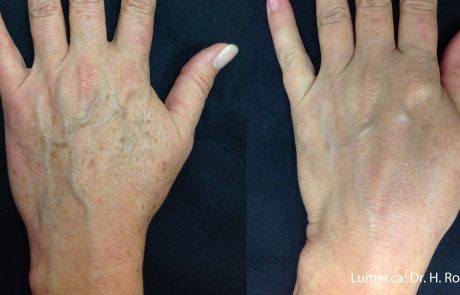 HR_Lumecca_2a_LeftHand_1TX_cropped-scaled