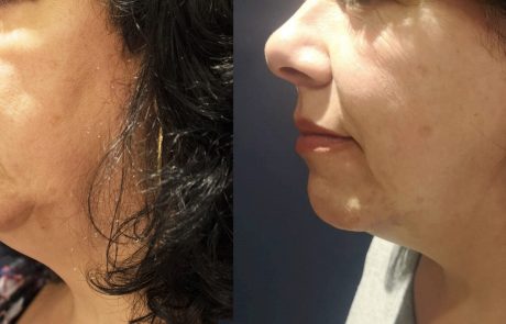 IM_Morpheus8_1b_Before_3monthsAfter-scaled